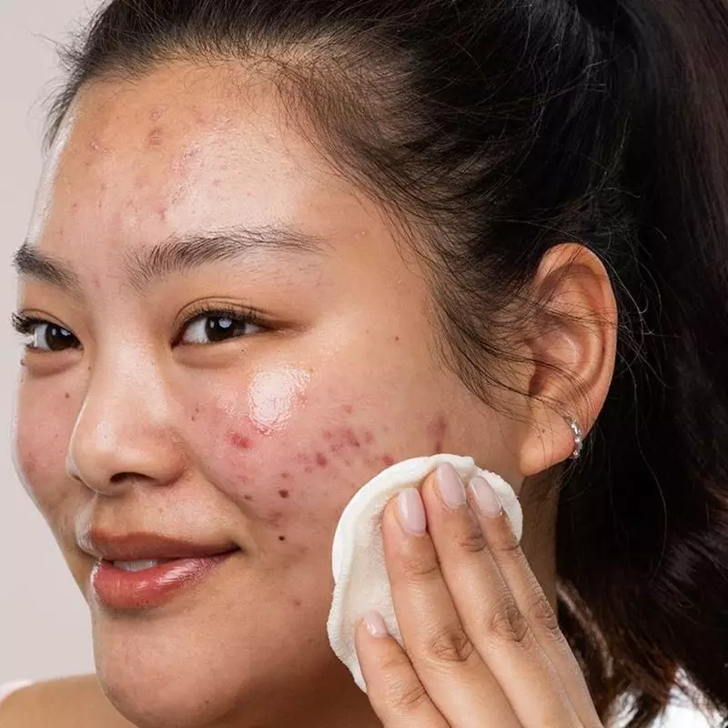 Jeune femme appliquant un soin avec coton sur peau acnéique, style avant-après montrant les bienfait
