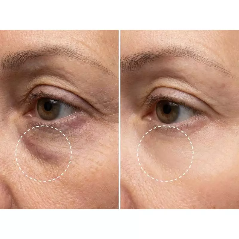 Comparaison avant-après sur peau foncée : gauche montre cernes et rides sous les yeux entourés, droi