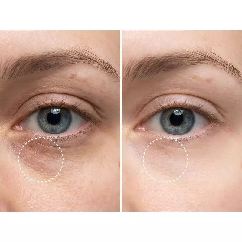 Avant-après zone des yeux sur peau claire : gauche avec cernes et poches cerclés, droite plus lisse 